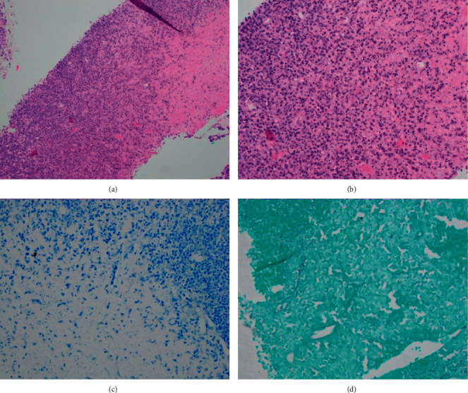 Kikuchi-Fujimoto Disease: A Differential for When It is Not Systemic Lupus Erythematosus.