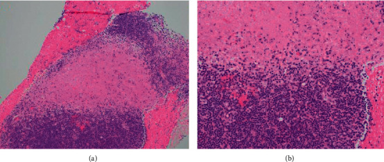 Kikuchi-Fujimoto Disease: A Differential for When It is Not Systemic Lupus Erythematosus.