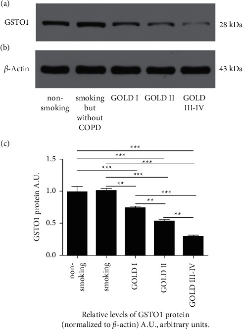 The Role of CD40, CD86, and Glutathione S-Transferase Omega 1 in the Pathogenesis of Chronic Obstructive Pulmonary Disease.