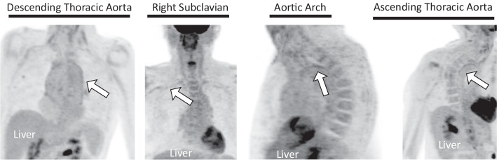 Combined modality PET/MR for the detection of severe large vessel vasculitis.