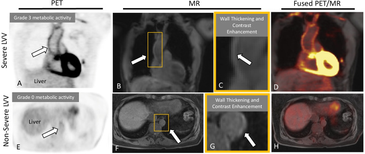 Combined modality PET/MR for the detection of severe large vessel vasculitis.