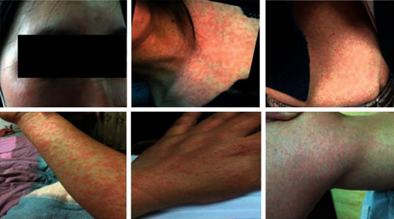 An Outbreak of Coxsackievirus A6 Infection in Adults of a Collective Unit, China, 2019.