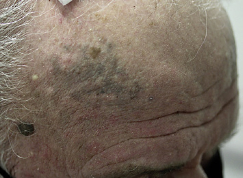 Blue Skin, Nail, and Scleral Pigmentation Associated with Minocycline.