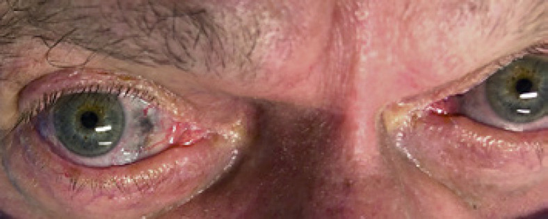 Blue Skin, Nail, and Scleral Pigmentation Associated with Minocycline.