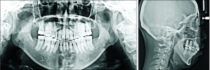 Clinical application of maxillary tissue bone-borne expander and biocreative reverse curve system in the orthodontic retreatment of severe anterior open bite with transverse discrepancy: A case report.