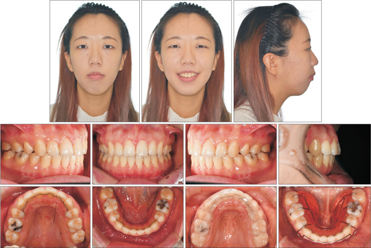 Clinical application of maxillary tissue bone-borne expander and biocreative reverse curve system in the orthodontic retreatment of severe anterior open bite with transverse discrepancy: A case report.