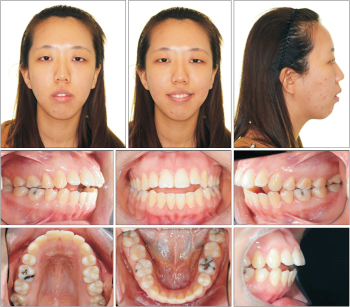 Clinical application of maxillary tissue bone-borne expander and biocreative reverse curve system in the orthodontic retreatment of severe anterior open bite with transverse discrepancy: A case report.