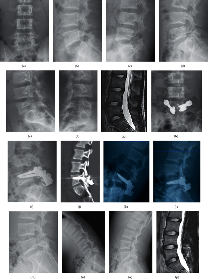 Surgical Reduction and Direct Repair Using Pedicle Screw-Rod-Hook Fixation in Adult Patients with Low-Grade Isthmic Spondylolisthesis.