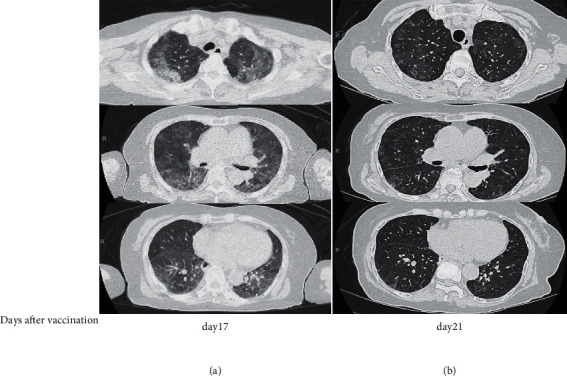 Transient Pneumonitis as a Possible Adverse Reaction to the BNT162b2 COVID-19 mRNA Vaccine in a Patient with Rheumatoid Arthritis: A Case Report and Review of the Literature.