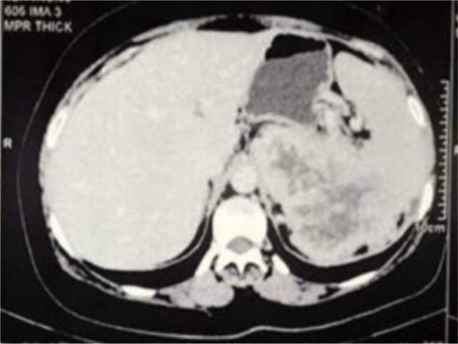 Successful Surgical Management of Locally Advanced Renal Cell Carcinoma Invading Spleen and Pancreas.