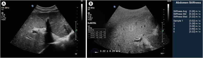 A case report of toxic hepatitis caused by chloroform in automotive parts manufacturer coating process.