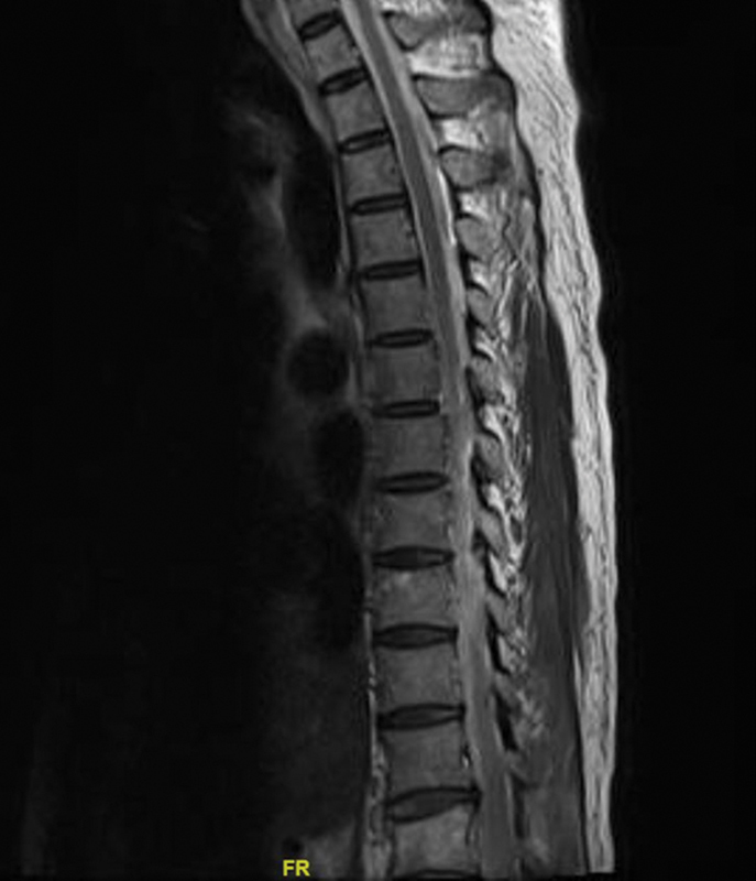 Guillain-Barre Syndrome-A Rare Cause of Quadriparesis after the Bentall Procedure for Type A Aortic Dissection.