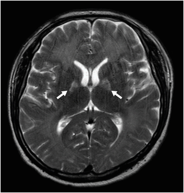 Carbon monoxide poisoning-induced encephalopathy in a carbon dioxide arc welder: a case report.