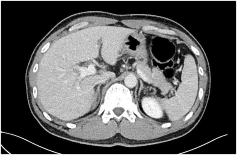 A case report of toxic hepatitis caused by chloroform in automotive parts manufacturer coating process.