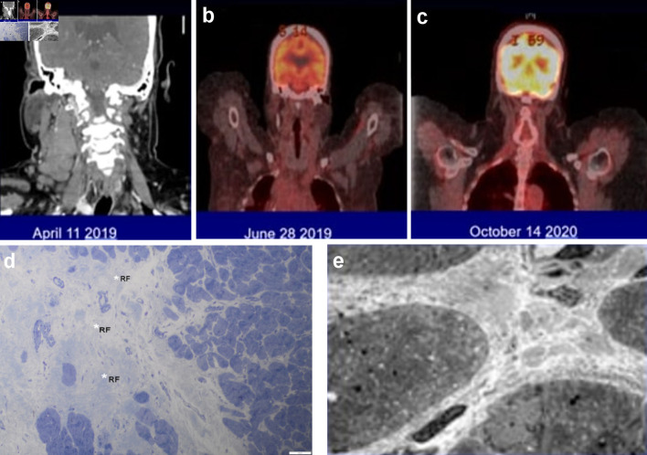 Durable Remission in Hodgkin Lymphoma Treated With One Cycle of Bleomycin, Vinblastine, Dacarbazine and Two Doses of Nivolumab and Brentuximab Vedotin.