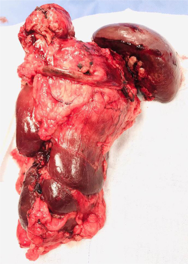 Successful Surgical Management of Locally Advanced Renal Cell Carcinoma Invading Spleen and Pancreas.