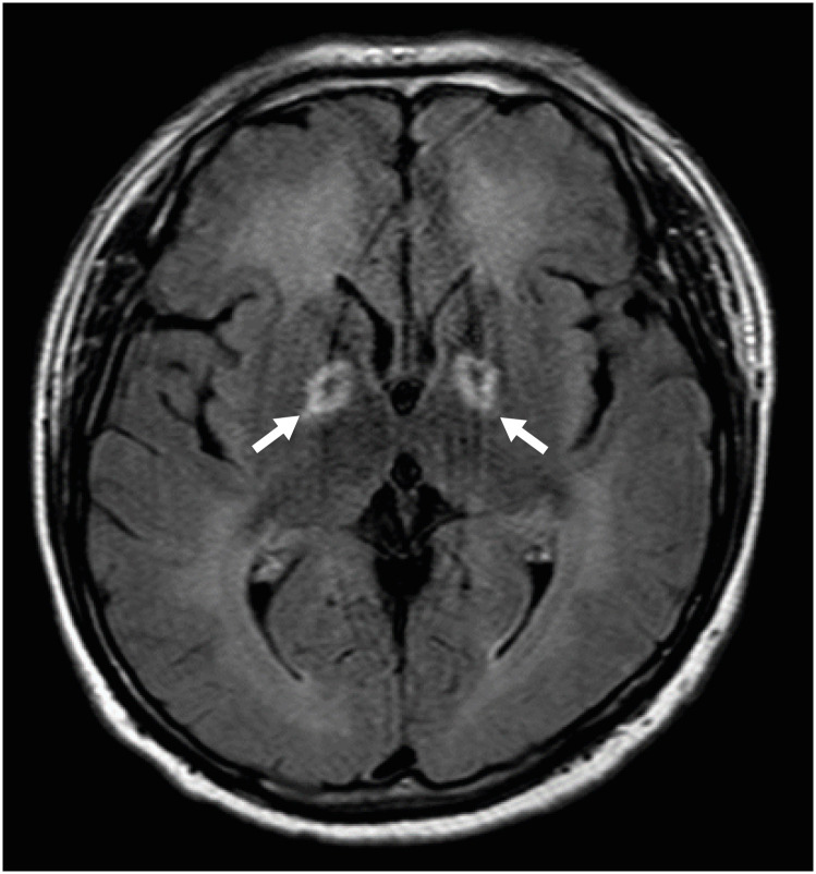 Carbon monoxide poisoning-induced encephalopathy in a carbon dioxide arc welder: a case report.