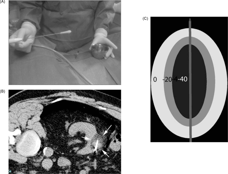Modern Management of Localized Renal Cell Carcinoma- Is Ablation Part of the Equation?