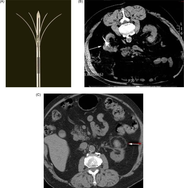 Modern Management of Localized Renal Cell Carcinoma- Is Ablation Part of the Equation?