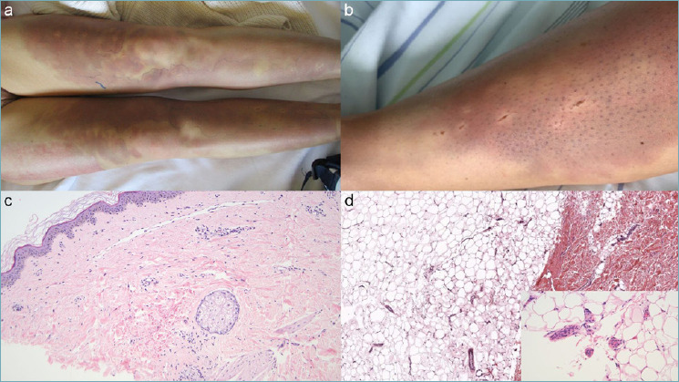 Livedoid skin reaction to 2nd dose of mRNA Covid-19 vaccine.