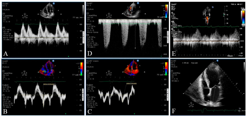 Heart Dysfunction in Essential Hypertension Depends on Systemic Proinflammatory Influences: A Retrospective Clinical Pathophysiological Study.