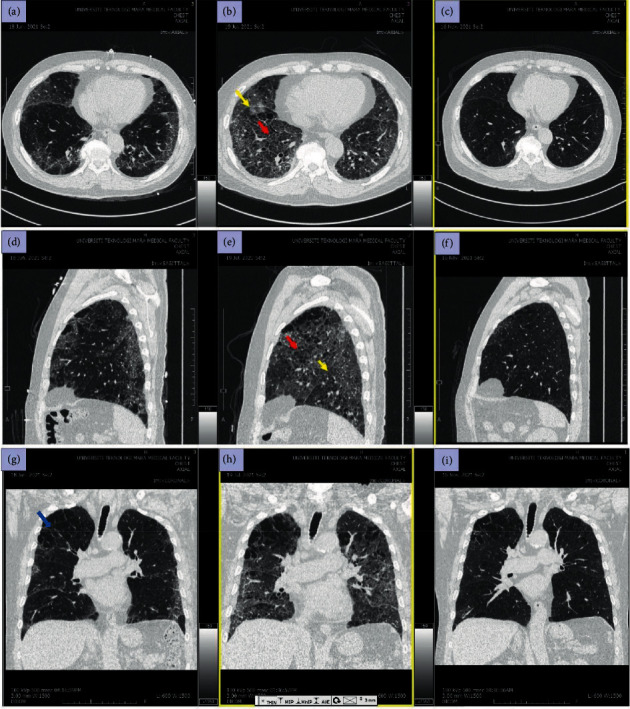 Managing Post COVID-19 Patient with Breathlessness.