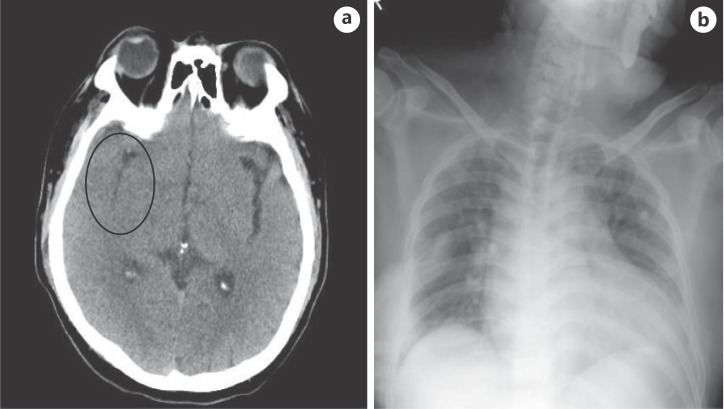 The Development of Pulmonary Edema after Recombinant Tissue Plasminogen Activator in Acute Ischemic Stroke Patient; Neurogenic or Non-Neurogenic?