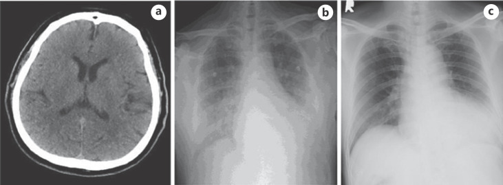 The Development of Pulmonary Edema after Recombinant Tissue Plasminogen Activator in Acute Ischemic Stroke Patient; Neurogenic or Non-Neurogenic?