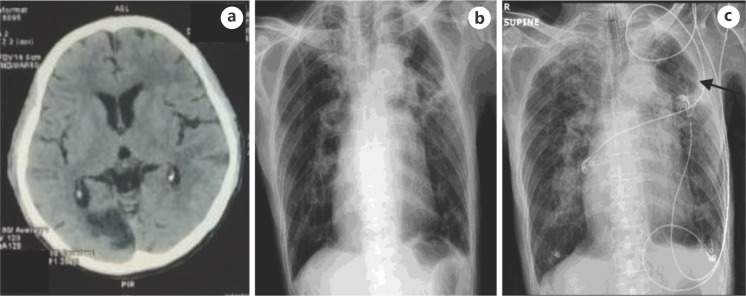 The Development of Pulmonary Edema after Recombinant Tissue Plasminogen Activator in Acute Ischemic Stroke Patient; Neurogenic or Non-Neurogenic?