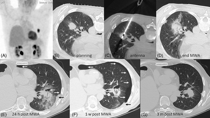 Current trends in image-guided chest interventions.