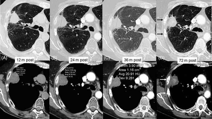 Current trends in image-guided chest interventions.