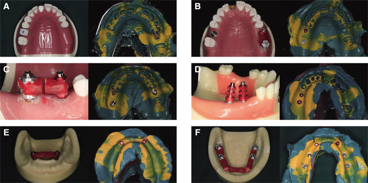 Comparison of accuracy between digital and conventional implant impressions: two and three dimensional evaluations.