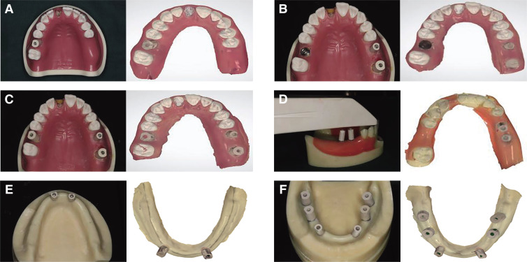 Comparison of accuracy between digital and conventional implant impressions: two and three dimensional evaluations.