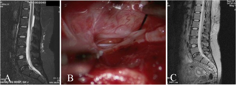 How to locate the dural defect in a spinal extradural meningeal cyst: a literature review.