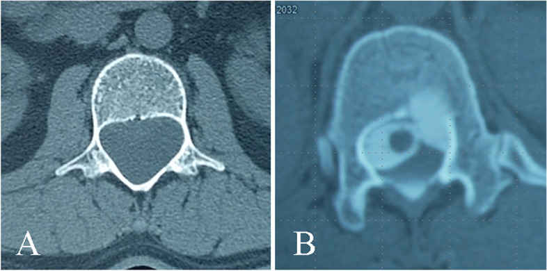 How to locate the dural defect in a spinal extradural meningeal cyst: a literature review.