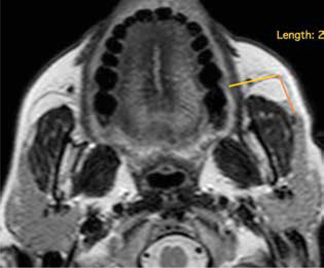 The role of magnetic resonance imaging and magnetic resonance sialography in the evaluation of salivary sialolithiasis: radiologic-endoscopic correlation.