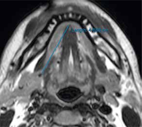 The role of magnetic resonance imaging and magnetic resonance sialography in the evaluation of salivary sialolithiasis: radiologic-endoscopic correlation.