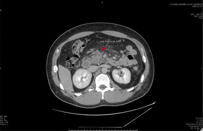 Spontaneous Acute Mesenteric Thrombosis in a Patient With Hemoglobin E Thalassemia.