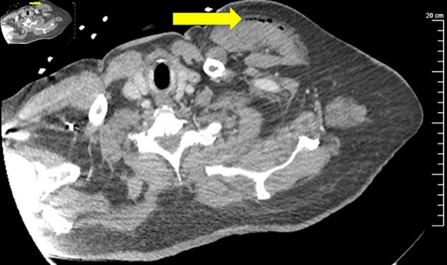 Unusual Case of Non-HIV Patient With Multifocal Pyomyositis: Developed on Appropriate Antibiotic Therapy.