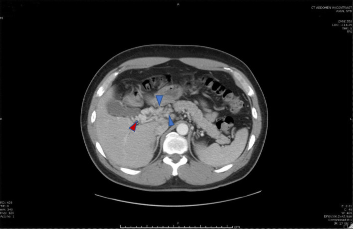 Spontaneous Acute Mesenteric Thrombosis in a Patient With Hemoglobin E Thalassemia.