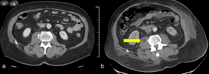 Unusual Case of Non-HIV Patient With Multifocal Pyomyositis: Developed on Appropriate Antibiotic Therapy.