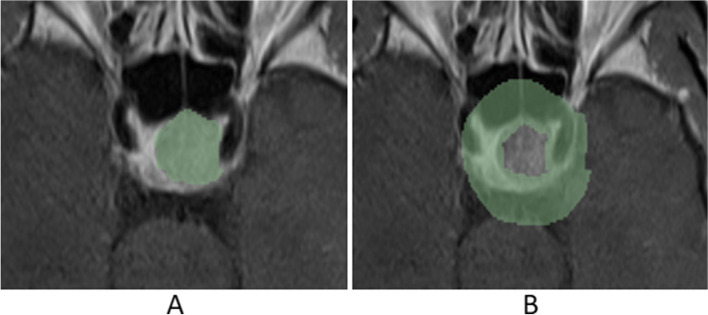 Prediction of high infiltration levels in pituitary adenoma using MRI-based radiomics and machine learning.