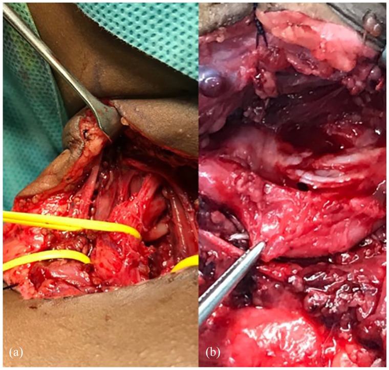 Microsurgery in pediatric upper limb reconstructions: An overview.