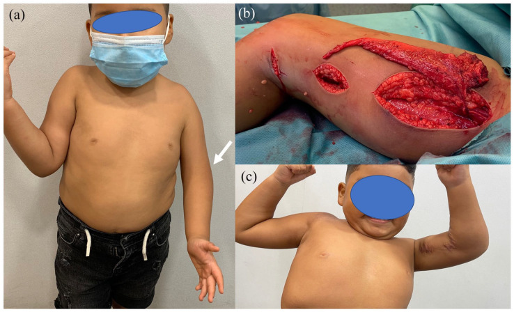 Microsurgery in pediatric upper limb reconstructions: An overview.