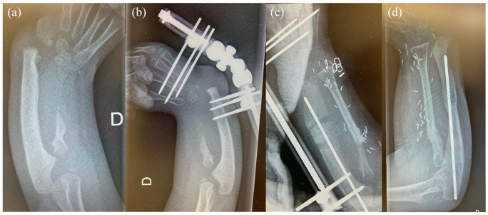Microsurgery in pediatric upper limb reconstructions: An overview.
