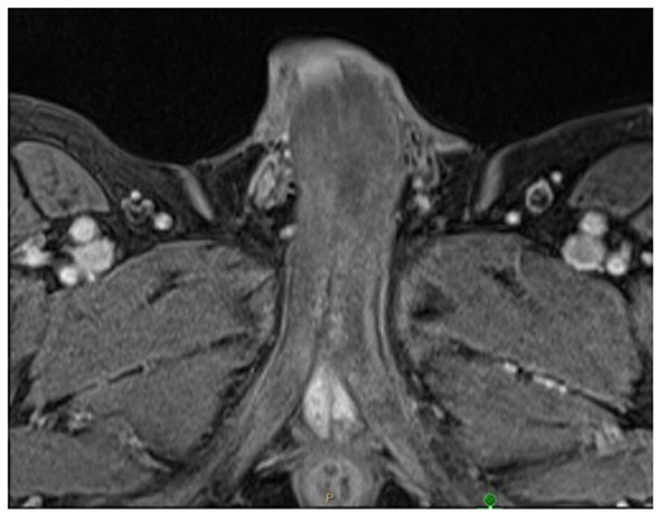 Recent advances in understanding and treating priapism.