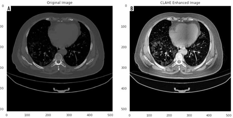 Automated deep learning-based segmentation of COVID-19 lesions from chest computed tomography images.