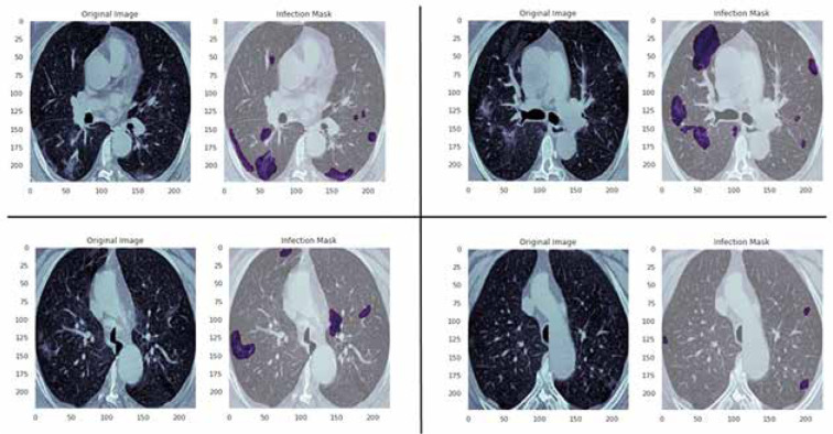 Automated deep learning-based segmentation of COVID-19 lesions from chest computed tomography images.