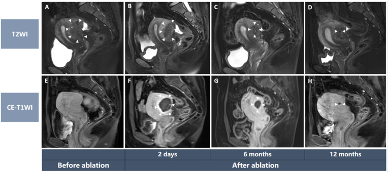 Ultrasound-guided microwave ablation for symptomatic adenomyosis: More areas of concern for more uniform and promising outcomes