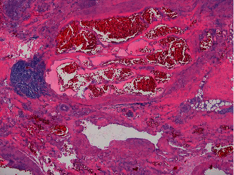 Case Report of Fibro-Adipose Vascular Anomaly (FAVA) with Activating Somatic <i>PIK3CA</i> Mutation.